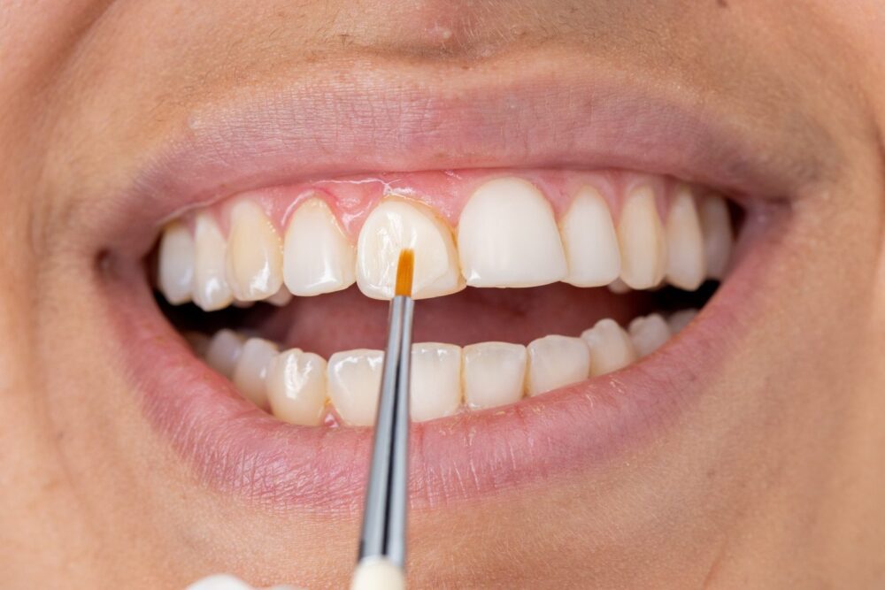 الترابط المركب